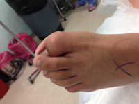 Overlapping toes - causes and treatment